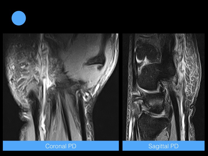 Figure 2 for case Hypothenar Hammer Syndrome